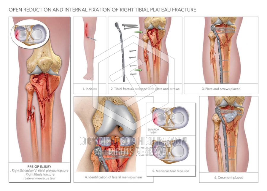 Open Reduction And Internal Fixation Of Right Tibial Plateau