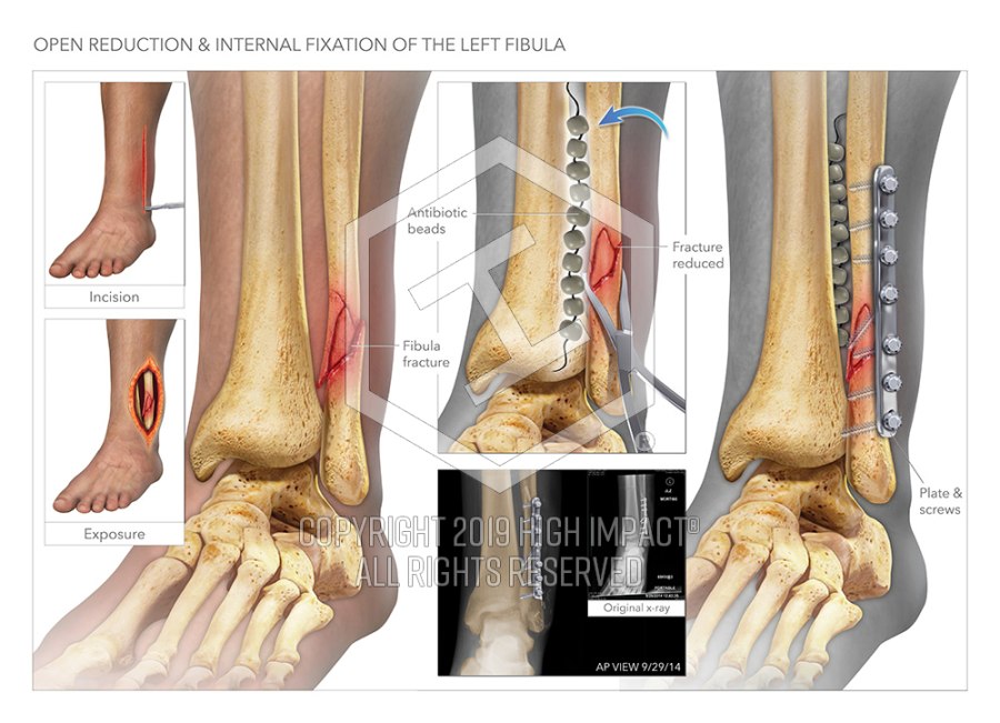 Open Reduction Internal Fixation of the Fibula | High Impact® Visual