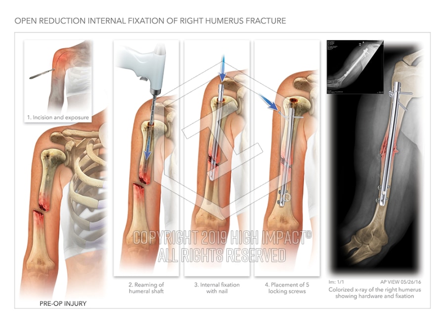 Open Reduction Internal Fixation Of Right Humerus Fracture High
