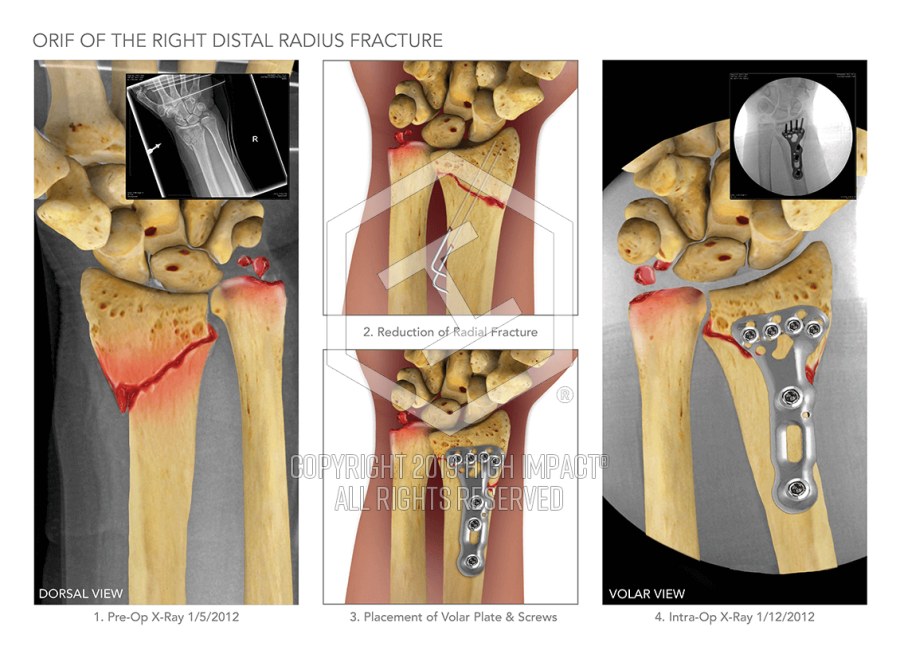 cpt orif distal fibula fracture