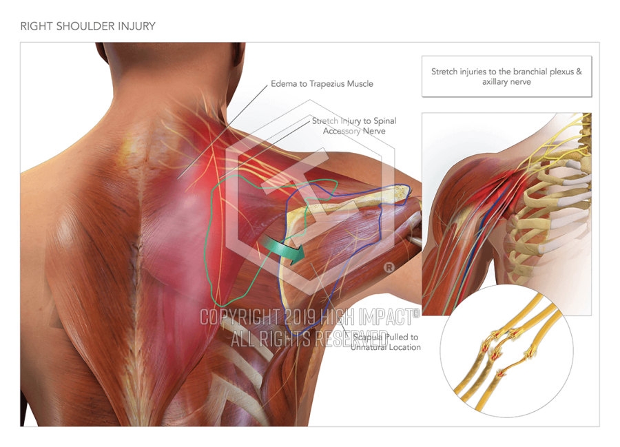 Right Shoulder Injury Amp Corrective Surgery High Impact Visual Litigation Strategies