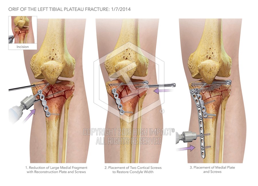 Open Reduction Internal Fixation Of The Tibial Plateau