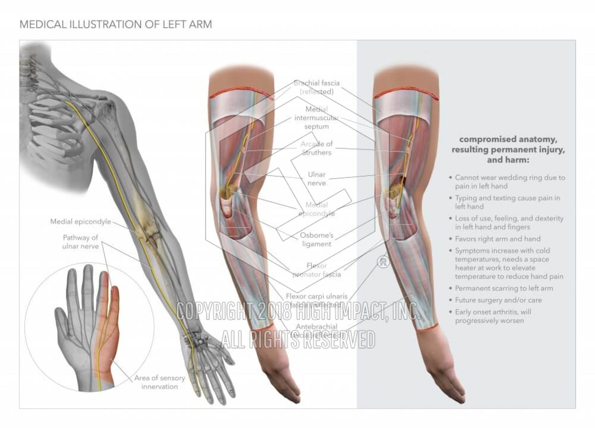 Medical Illustration Of Left Arm High Impact Visual