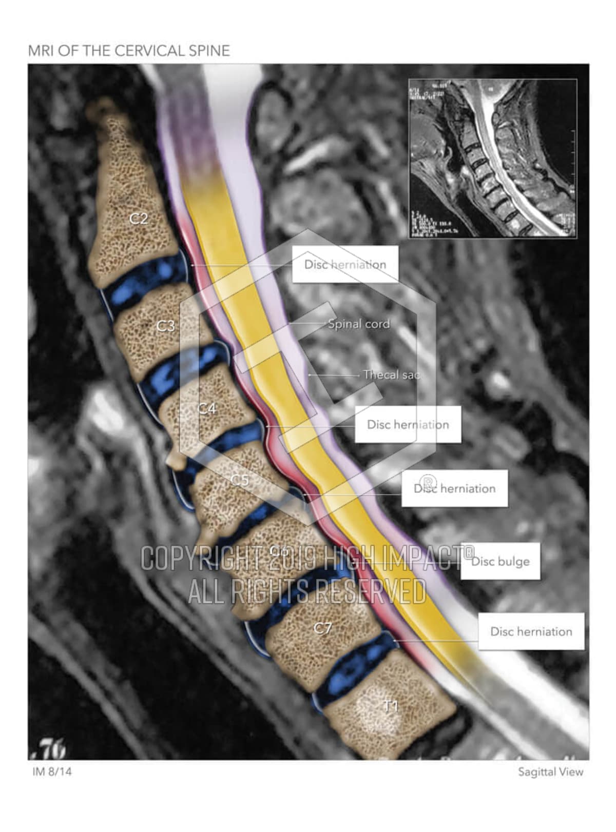 Mri Of The Cervical Spine High Impact Visual Litigation