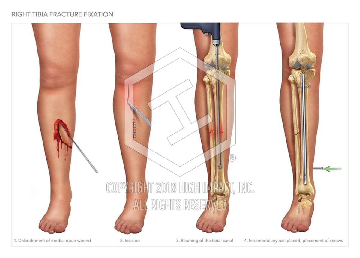 right tibia fracture fixation high impact visual tibia