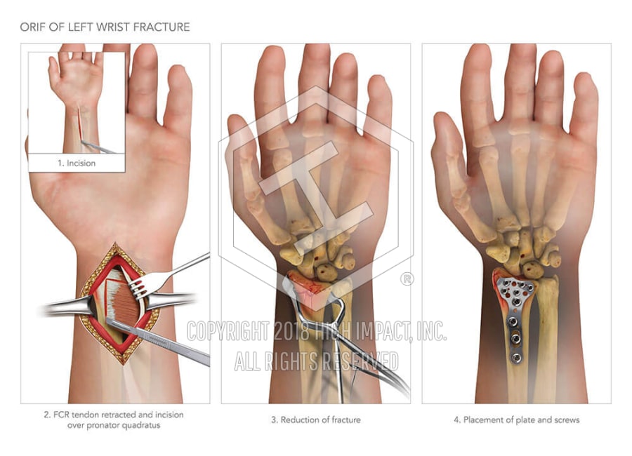 ORIF Of Left Wrist Fracture High Impact Visual Litigation Strategies