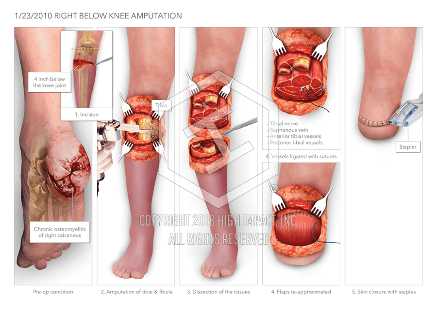 Below amputation xanax knee