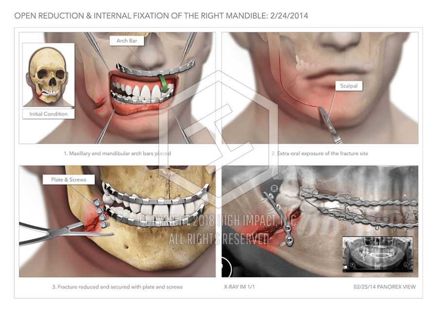 open reduction internal fixation