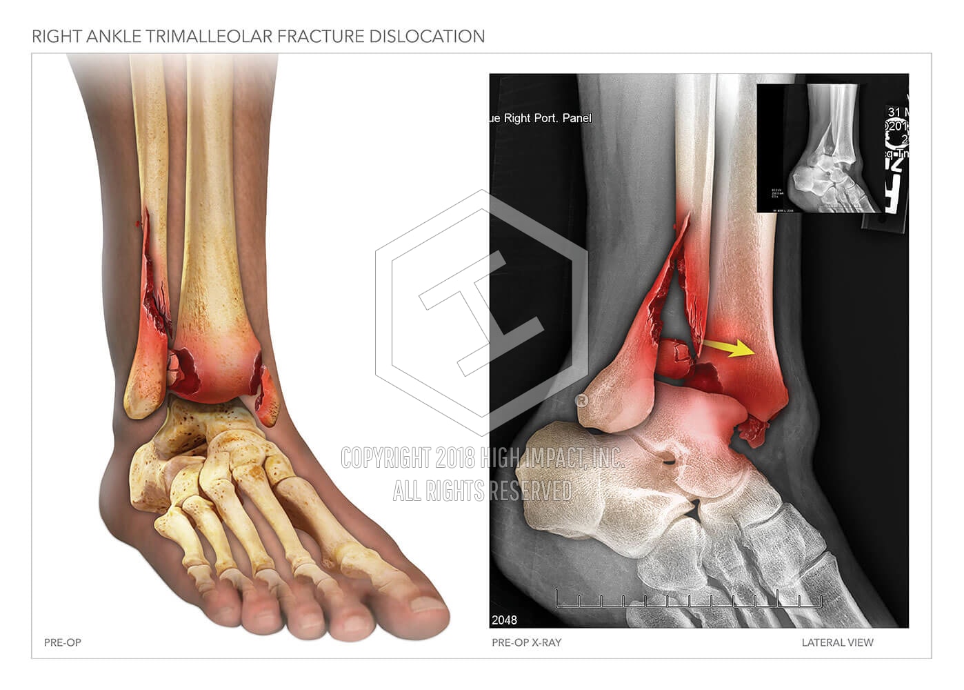 trimalleolar fracture