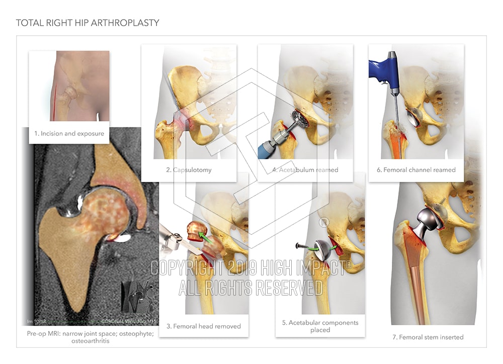 Personal Narrative: My Left Hip Surgery