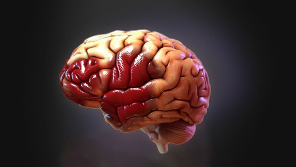$29M Verdict 3D Mapping Brain Damage | High Impact® Visual ...