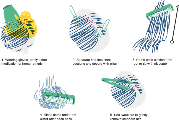 Illustration of how to get rid of lice
