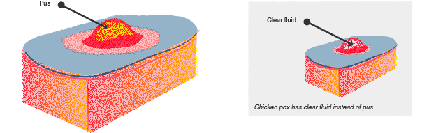 Chickenpox vs MRSA illustrated