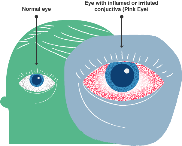 Illustration of a healthy eye vs infected pink eye