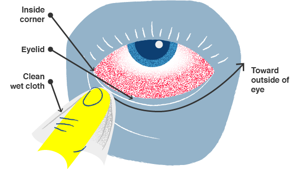 Illustration, how to clean an eye infected with pink eye