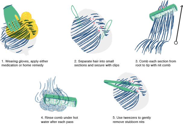 Illustration of how to get rid of lice