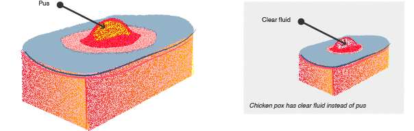 Chickenpox vs MRSA illustrated