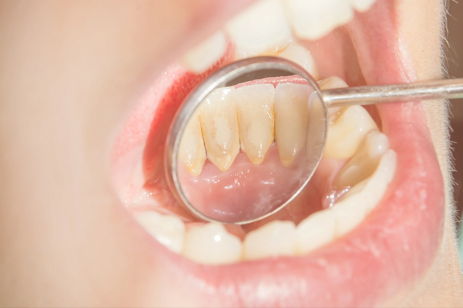 Dental tartar: what is it and how to avoid it