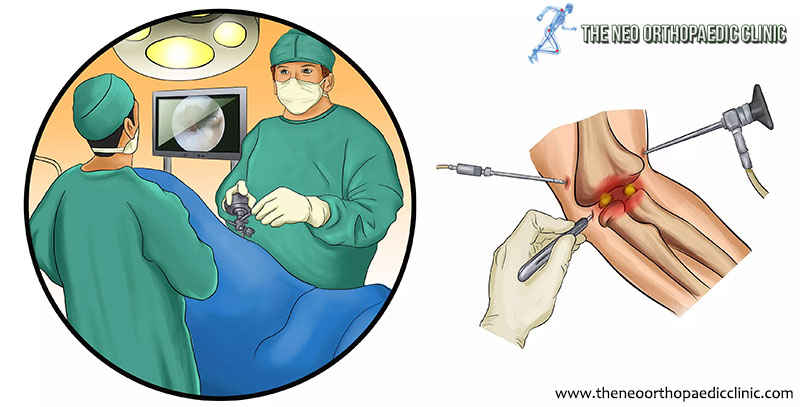 ARTHROSCOPY: DIAGNOSTIC AND THERAPEUTIC PROCEDURE ON THE RISE