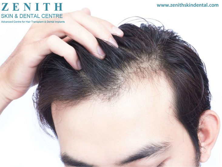 Alopecia and testosterone, is there a relationship?