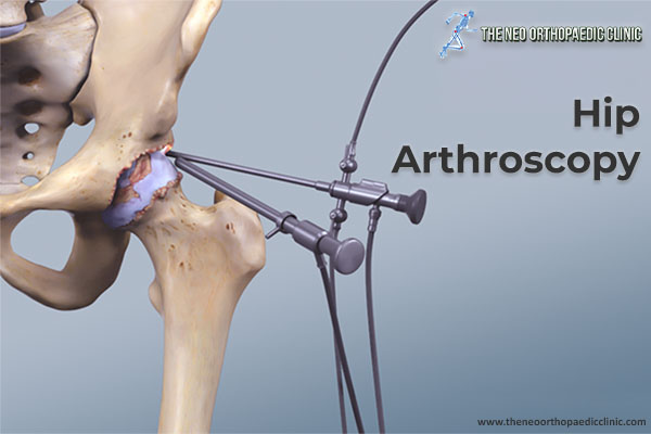 Hip arthroscopy in athletes: eliminate exercise pain