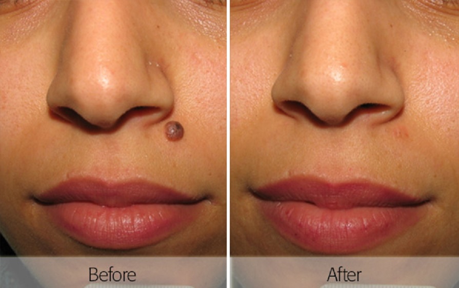 When should you remove moles?