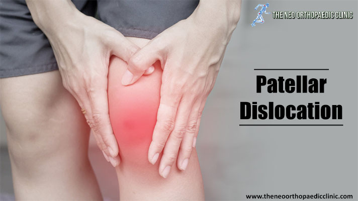 Patellar Instability or Patellar Dislocation