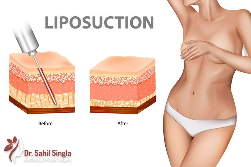 Abdominal Liposuction Procedure in Delhi