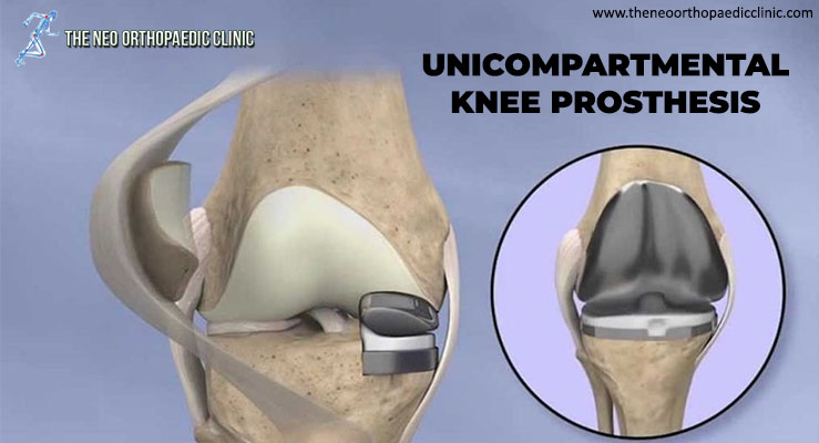 UNICOMPARTMENTAL KNEE PROSTHESIS