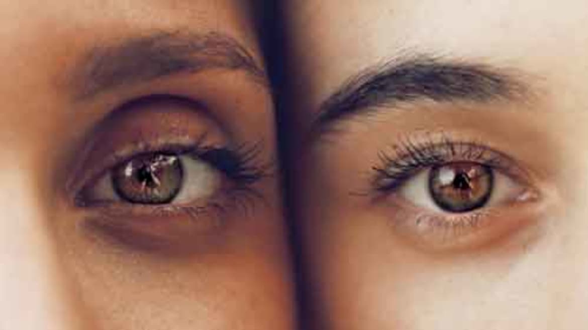 Heroin causes a look of exhaustion, including droopy eyelids and dark circles beneath their eyes. Droopy eyelids