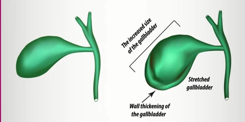 gall bladder inflammation