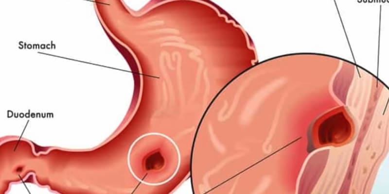 stomach ulcer treatment