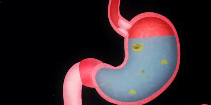 causes of stomach acid