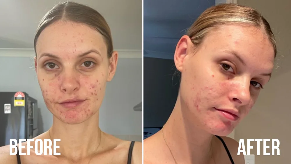 Non Surgical Face Lift(03)