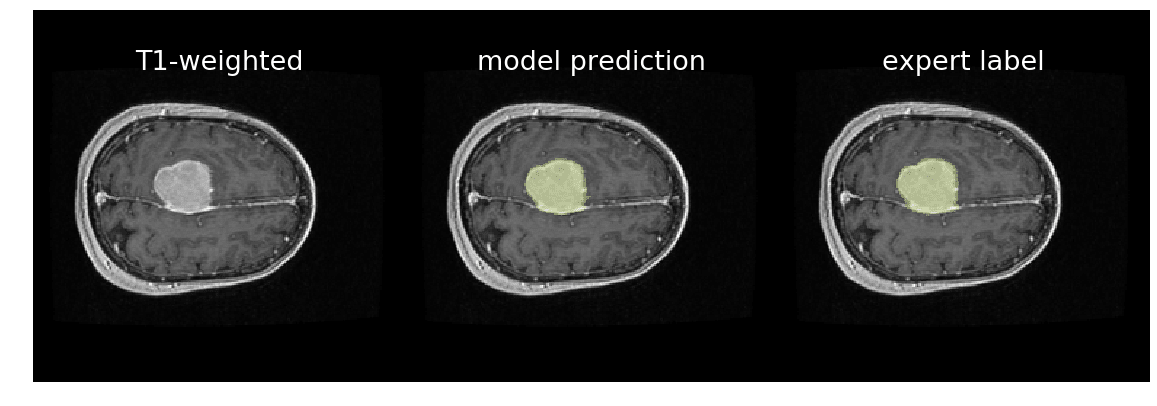 Meningioma extraction model prediction