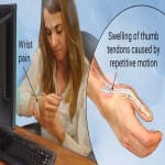 depicts where dequervan affects the hands