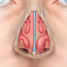 enlarged turbinate