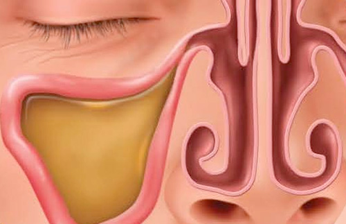 sinus balloon diagram