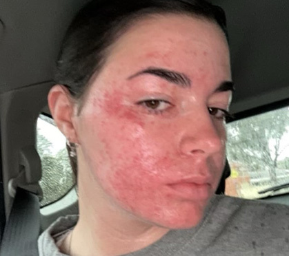Young woman with extreme psoriasis before using Grace Cosmetics.