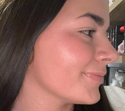 Young woman with extreme psoriasis after using Grace Cosmetics skincare for Eczema & Psoriasis