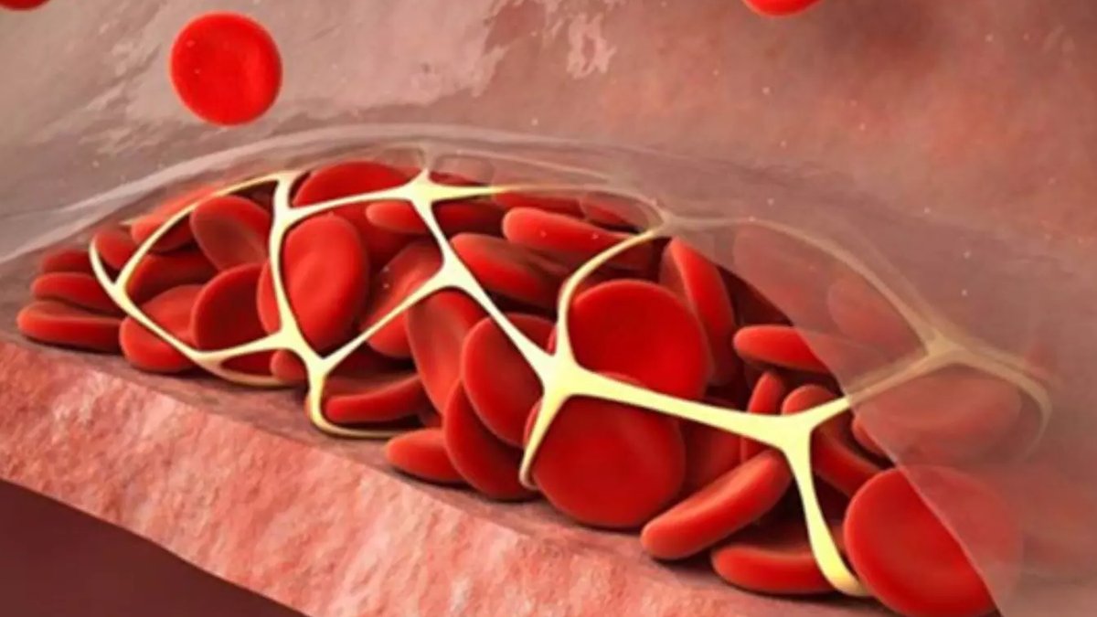 Tenecteplase Reduces Stroke Treatment Delays vs Alteplase - stroke treatment delays
