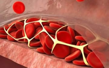 Tenecteplase Reduces Stroke Treatment Delays vs Alteplase