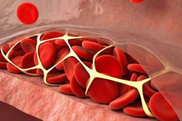 Tenecteplase Reduces Stroke Treatment Delays vs Alteplase