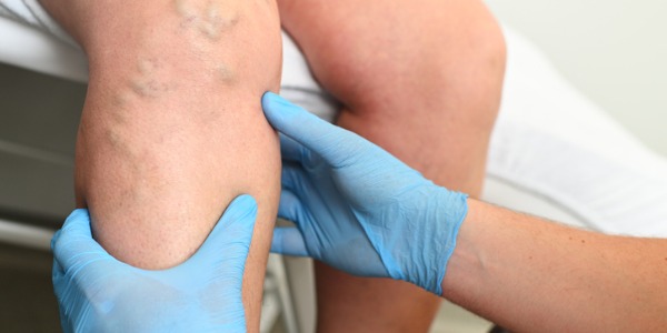A vascular medicine specialist looking at the veins on a patient's leg.