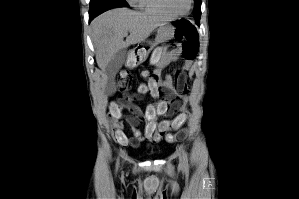 Köln – Mann mit 450 Gramm Kokain und 300 Gramm Heroin im Körper