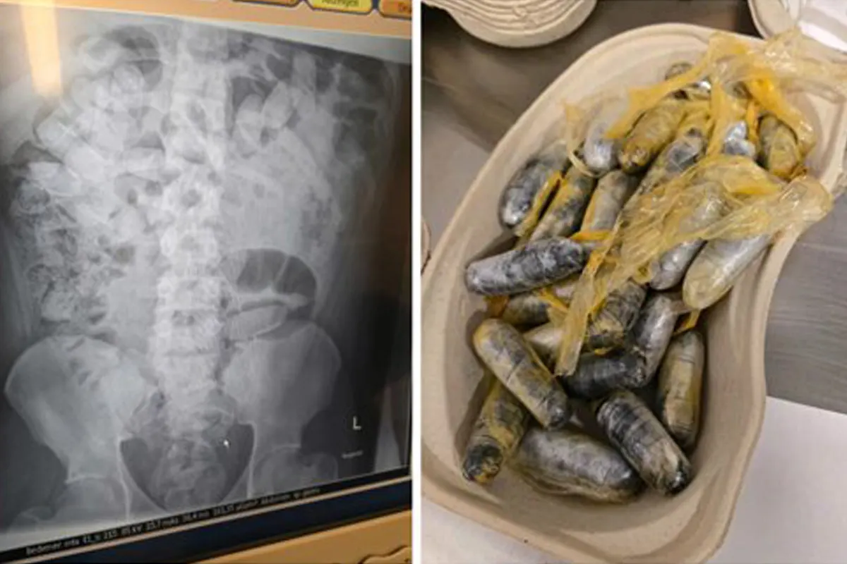 Das Bild zeigt links eine Röntgenaufnahme, die den Bauchbereich eines Menschen darstellt, und rechts mehrere in Plastik eingewickelte, wurstförmige Pakete in einer braunen Schale.