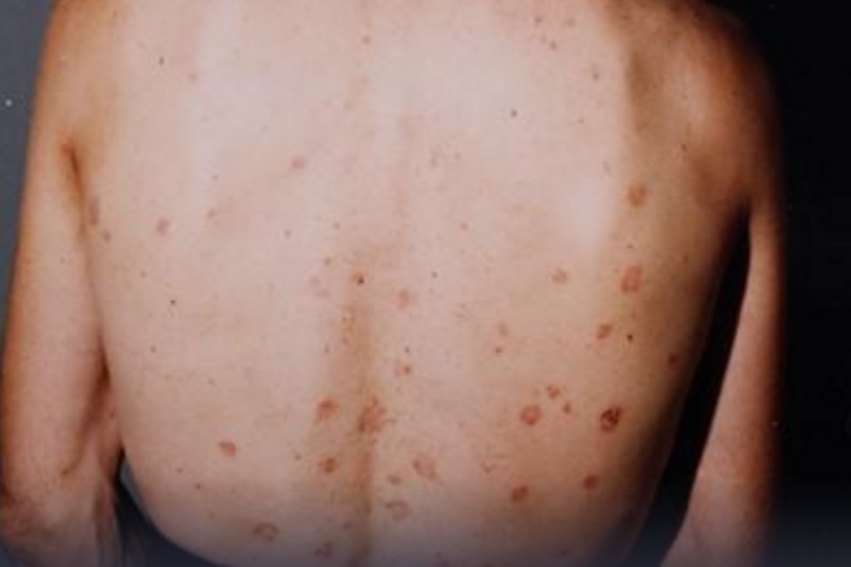 Oberkörper des Tatverdächtigen mit auffälligen Hautmerkmalen