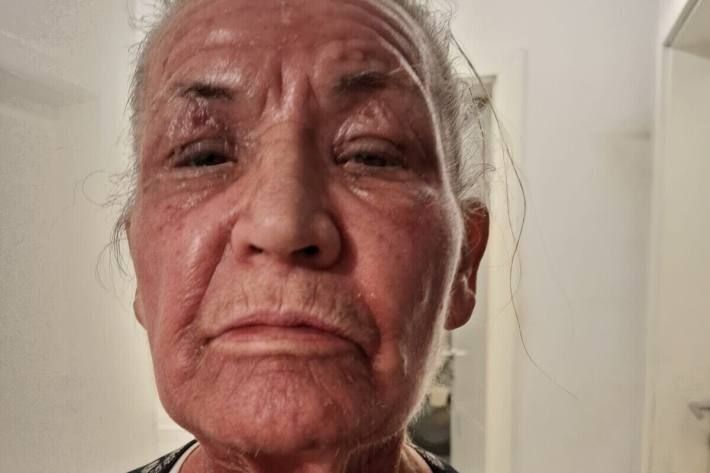 Die Vermisste hat aufgrund einer Hautkrankheit eine auffallend dunkle Haut im Gesicht (ähnlich einer Solariumbräune)