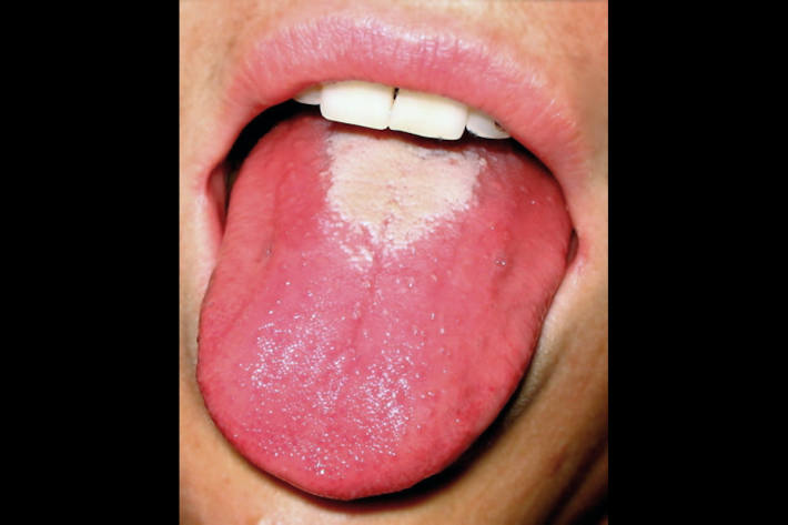 Erdbeerzunge, auch Himbeerzunge genannt, mit weissem Belag. Symptom für die Krankheit Scharlach (Symbolbild)