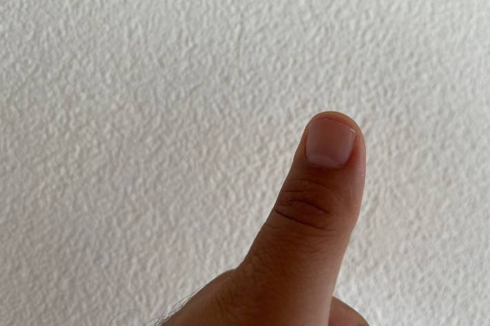 In Birsfelden BL wurde ein Daumen aufgefunden. Die Polizei hat nun ermittelt und herausgefunden, was passiert ist. (Symbolbild)